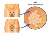 hpv-human-papillomavirus-21932351.jpg