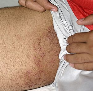 fungal_infection_tinea_cruris_jock_itch.jpg